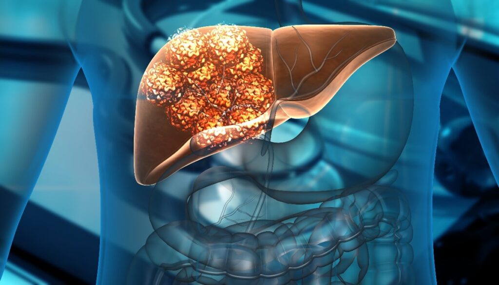 Introduction to Liver Cancer